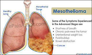 Image result for Mesothelioma, The remedy And Claims