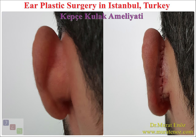 Ear Plastic Surgery - Pinna (or Auricle) Anatomy - Definition of Protruding Ear or Prominent Ear - Protruding Ear Surgery - Mustardé Technique - Animated Presentation - Pitanguy Technique - Modified Technique - Conchomastoid Technique - Postoperative Patient Care After Protruding Ear Surgery - Kepçe Kulak Ameliyatı