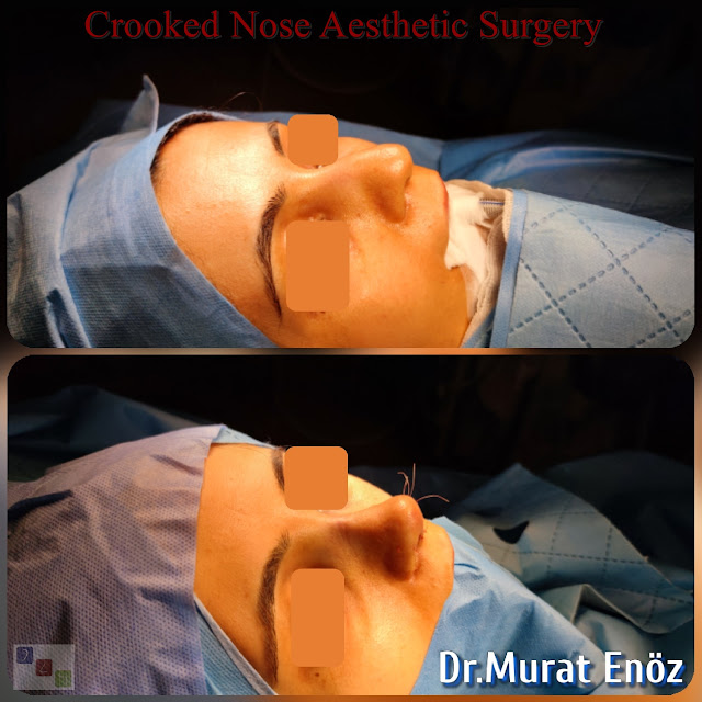 Rhinoplasty Operation For Crooked Nose,Crooked Nose Aesthetic Surgery For Female,Twisted Nose Rhinoplasty,