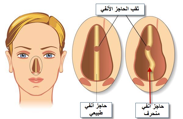 ثقب الحاجز الأنفي