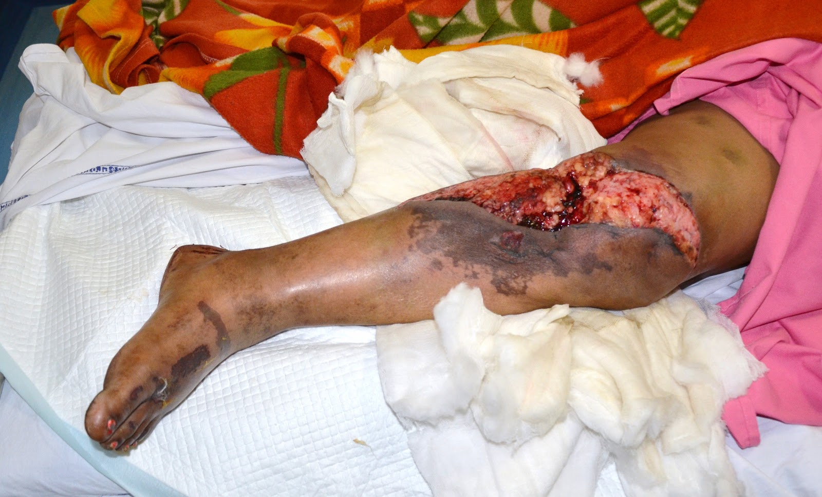 CRUSH INJURY FOOT, LOWER LIMB INJURIES AND LIMB SALVAGE: DEGLOVING