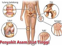 Cara Mengobati Asam Urat Yg Parah