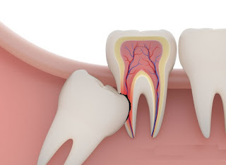 Có nên nhổ răng khôn mọc lệch ?