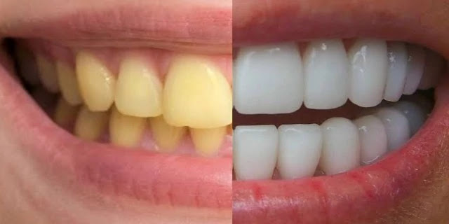 dant kaise saaf karen, how to get rid of teeth stains at home, daat ko kaise chamkaye, daant saaf kaise kare, daant saaf kaise kare gharelu nuskhe, pile daant saaf kaise kare, pile daant saaf karne ke upay, yellow teeth, yellow teeth home remedy, white teeth, safed daat, dant safed karne ke gharelu upay in hindi, teeth whitening, teeth white karne ka tarika, home remedies for teeth whitening, दांत साफ कैसे करें, दांत का पीलापन, सफेद दांत, दांत साफ करने के घरेलू नुस्खे, पीले दांत कैसे साफ करें, दांत का कालापन कैसे दूर करे, दांत का पीलापन हटाने का उपाय, dant kaise saaf karen, gande dant kaise saaf kare, dant ko saaf kaise kare, dant ka pilapan kaise saaf kare, ghar par dant kaise saaf karen