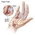 Perawatan Fisioterapi untuk Trigger Finger