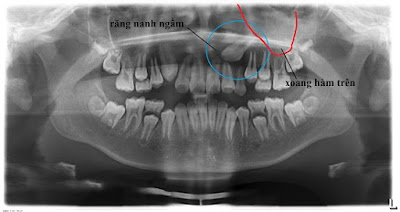 Cách điều trị răng nanh mọc ngầm trong xương hàm