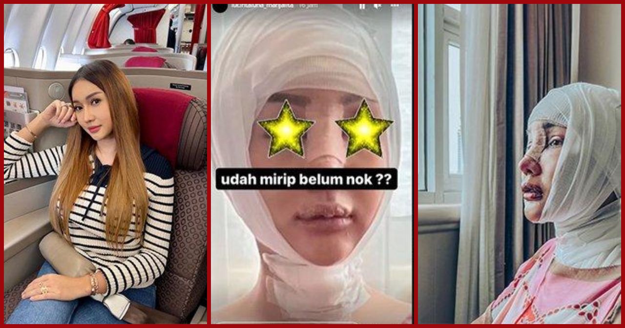 Potret Wajah Lucinta Luna setelah Operasi, Kepala Dibalut hingga Bibir Dijahit Berharap Mirip Jisoo