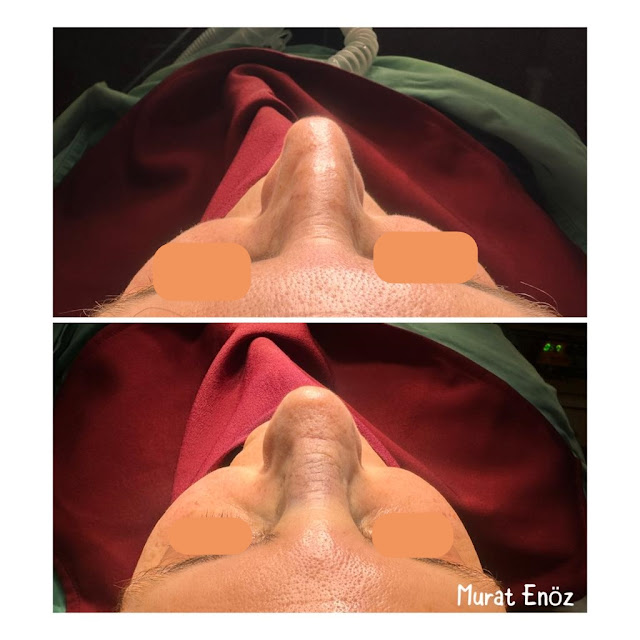 Why Does the Nose Tip Drop After Rhinoplasty?, Pig-like Nose After Nose Job, Excessively Raised Nose Tip After Cosmetic Nose Surgery