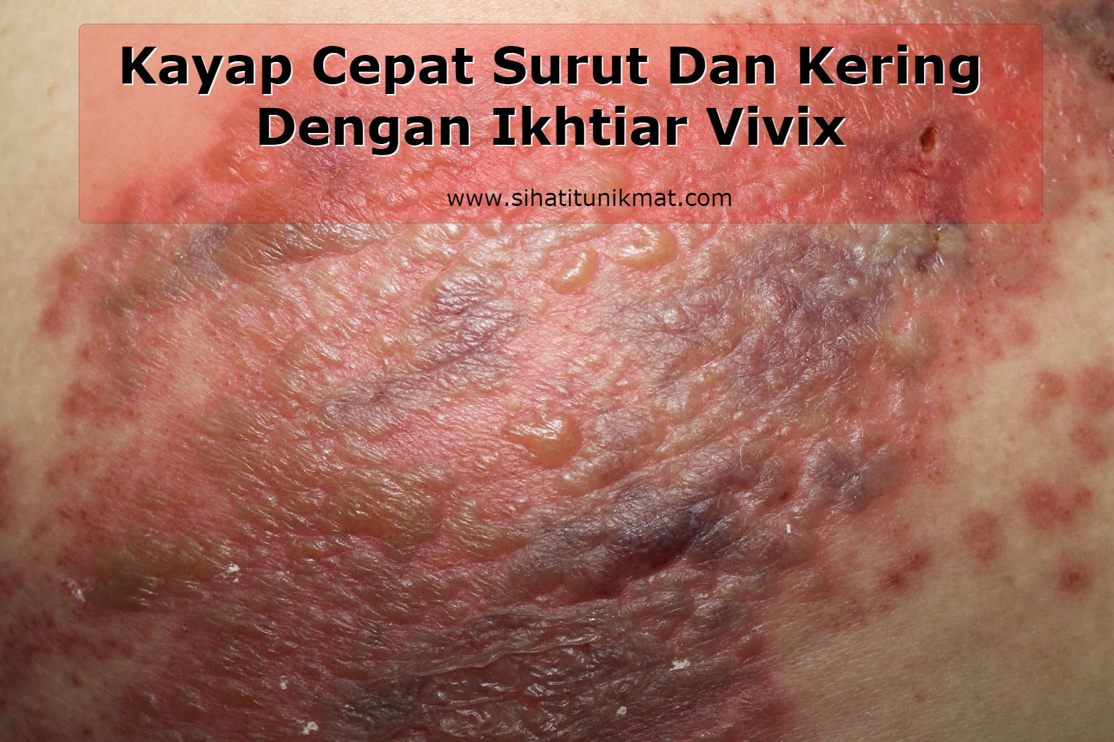 Kayap Cepat Surut Dan Kering Dengan Ikhtiar Vivix 