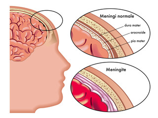 A importância do Dia Mundial da Meningite em nossa saúde pública