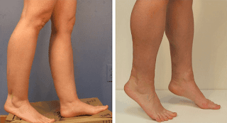 http://www.liposuctiontummytuck.in/legs-ankles.html