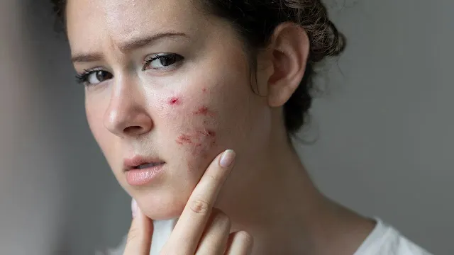 पित्त बढ़ने के कारण और बचाव: एक्सपर्ट से जानें उपाय Causes and Remedies for High Pitta