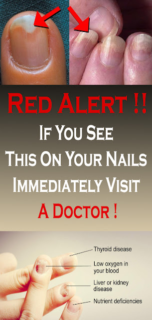 If You See This On Your Nails Immediately Visit A Doctor !