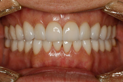 Tham khảo thông tin răng sứ cercon giá bao nhiêu-2