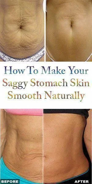 How to Lose Your Saggy Stomach – What Can You Do?