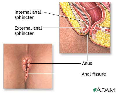 Masalah Sembelit (Constipation) ~ seribupilihan