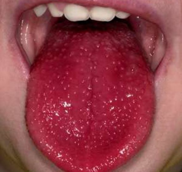 The appearance of your tongue has something to say about your health!