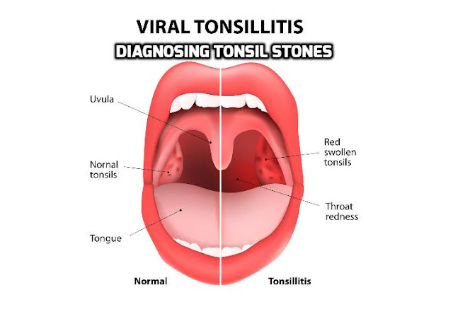 Tonsil stones, also known as tonsilloliths, are formed when decaying material is trapped in the crevices of your tonsils. Most people have small tonsil stones that do not cause noticeable symptoms. As a result, this condition is often discovered incidentally via X-rays or CT scans during the process of diagnosing tonsil stones.