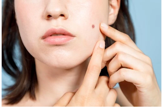 Home-Remedies-To-Remove-Moles 