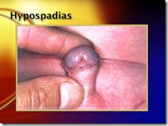 hypospadias medicalshow