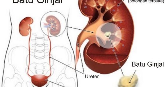 7 Penyakit  pada Sistem Ekskresi Ginjal Berpendidikan