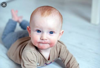 Baby rash on face