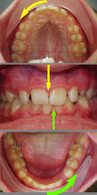 Несовпадение центра зубов