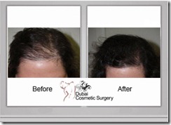 Hair-transplant-before-after-7