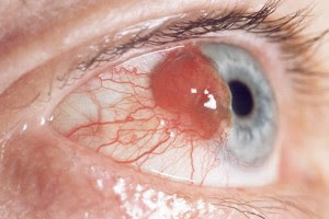 Ocular Melanoma Symptoms