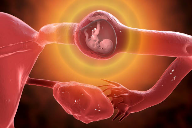 ectopic pregnancy definition,ectopic pregnancy definition, ectopic pregnancy meaning, ectopic pregnancy meaning in hindi, define ectopic, define ectopic pregnancy, tubal pregnancy definition, ectopic pregnancy meaning in english, tubal pregnancy meaning,What causes ectopic pregnancy?,Can a baby survive ectopic pregnancy?,What happens when you have an ectopic pregnancy?Is an ectopic pregnancy miscarriage?,How painful is ectopic?,Who is at risk of ectopic pregnancy?ectopic pregnancy causes,typesofectopicpregnancy,ectopic meaning,when ectopic pregnancy symptoms start,when does ectopic pregnancy pain start,ectopic pregnancy diagnosis,how common is ectopic pregnancy,complications of ectopic pregnancy
