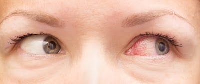 Eye allergies increase in spring