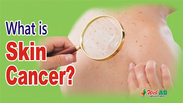 What Is Skin Cancer? | Types, Causes, and Treatment