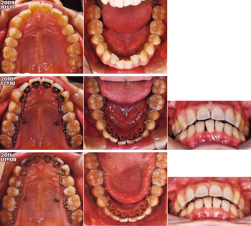 歯列矯正：定期検診その5