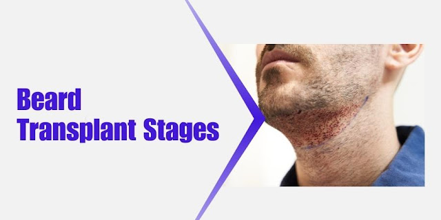 Beard Transplant Stages