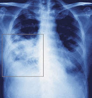 obat infeksi paru-paru