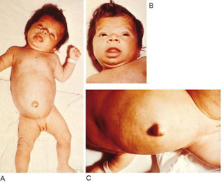 mixedem congenital