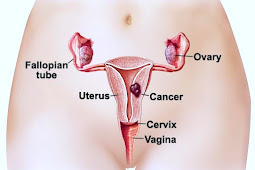 The Characteristics Of Uterine Cancer