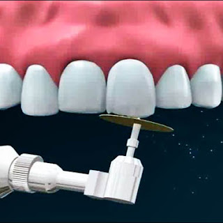 remodelacion dental