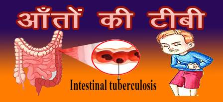 Intestinal tb image