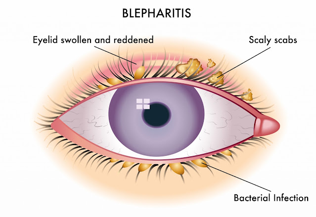 Blepharitis Treatment Market