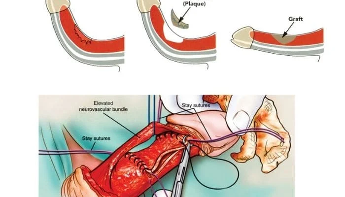 طريقة علاج تقوس القضيب