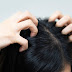 The Best Way to Cure Dandruff Permanently at Home