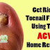 Easy Home Remedy to Get Rid of Toenail Fungus Naturally