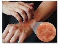 Gatal Tanpa Tahu Apa Pemicunya? Hati-hati Dermatitis