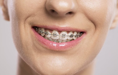 Niềng răng mắc cài kim loại có ưu điểm gì?