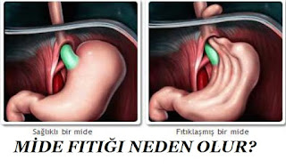 Mide Fıtığı Neden Olur?