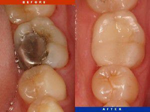 Địa chỉ thực hiện cấy ghép răng Implant 