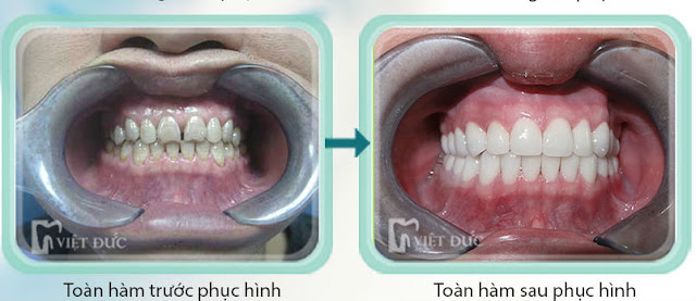 Hiệu quả sau khi phục hình răng sứ toàn sứ