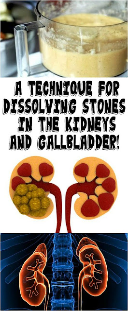 A TECHNIQUE FOR DISSOLVING STONES IN THE KIDNEYS AND GALLBLADDER!