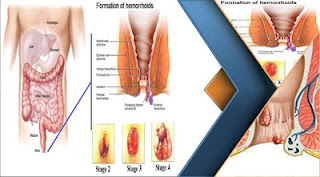 Penyakit Wasir